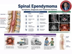 Spinal ependymoma_ symptoms, diagnosis, treatment