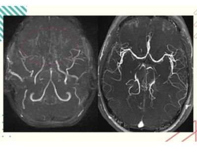Treatment of Moyamoya Disease