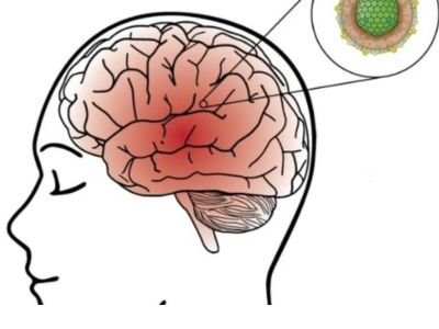 Types of Encephalitis
