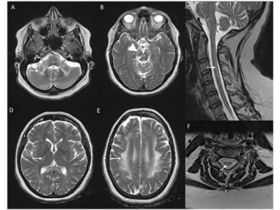 Types of Leukodystrophies
